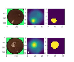 This image shows AI-powered vision analysis of the bottom of a hamburger bun. Even though they may look similar when analyzed on a rule-based system, in this application, the AI system can separate caked-on dough — an unwanted foreign anomaly on the product — from natural, acceptable air bubbles. This is displayed by the yellow segmentation on the different images. This image shows AI-powered vision analysis of the bottom of a hamburger bun. Even though they may look similar when analyzed on a rule-based system, in this application, the AI system can separate caked-on dough — an unwanted foreign anomaly on the product — from natural, acceptable air bubbles. This is displayed by the yellow segmentation on the different images.